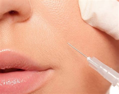 Các vị trí tiêm filler trên mặt an toàn mà bạn nên biết