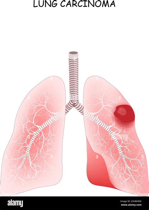 Pulmonary Carcinoma Stock Vector Images Alamy