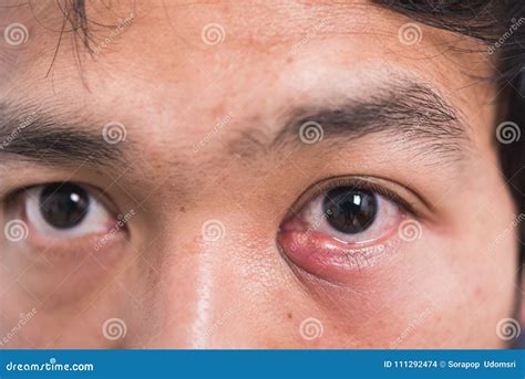 Close Up STYE HORDEOLUM CHALAZION Macro Detail Of An Eye Infection