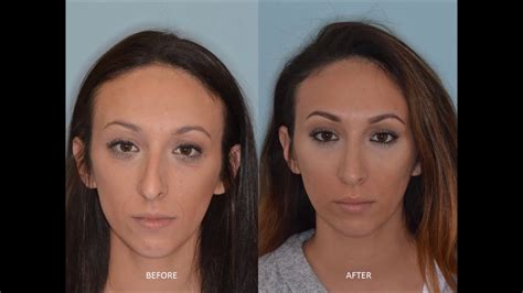 Refining Nasal Tip And Reducing Hump With Rhinoplasty Anthony Bared