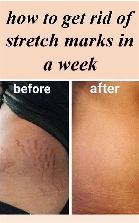 Stretch Marks Diagram