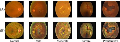 Retinal Scan Images Representing Five Different Severity Grades Of Download Scientific Diagram