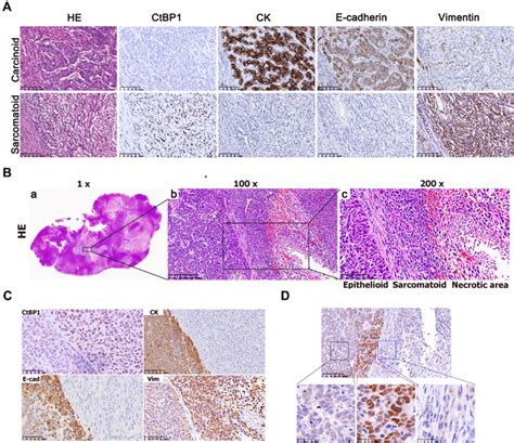 Ctbp1 Expression Is Upregulated In Sarcomatoid Hepatocellular Carcinoma