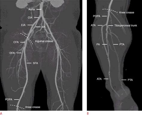 Lower Extremity Arteries Ultrasound