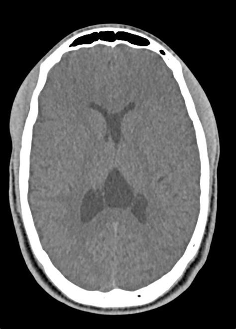 Learning Neuroradiology Case 1404 Cavum Septum