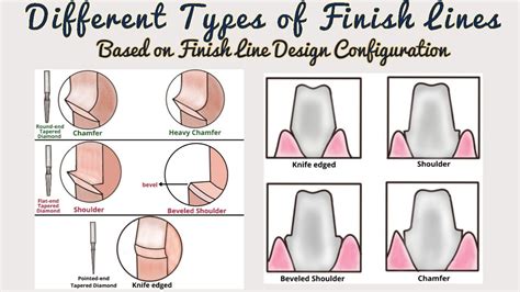 Types Of Finish Lines Based On Design Finish Lines In Fixed Partial