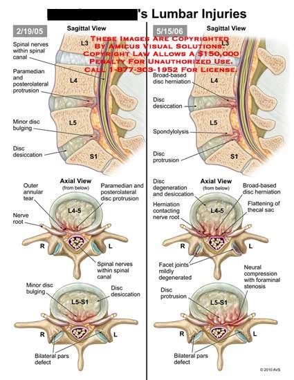 Amicus Illustration Of Amicusinjurylumbarspinevertebralcolumn