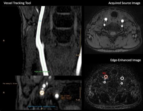 Spiral 3d Time Of Flight Mr Angiography For Rapid Non Contrast Carotid