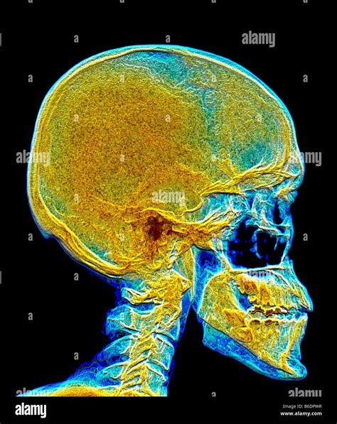 Human Skull Coloured X Ray Stock Photo Alamy