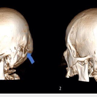 Preoperative Three Dimensional Reconstructed CT Scan Showing The Left