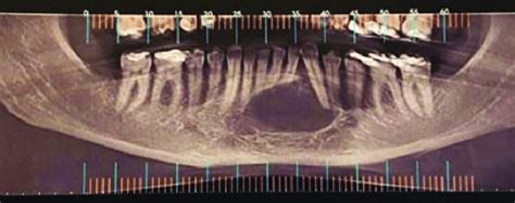 Radiografia Panor Mica Mostra Uma Les O Radiol Cida Halo Radiopaco