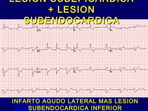 Isquemia Lesi N Y Necrosis Ppt Descarga Gratuita