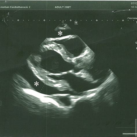 Plate A Axial Section Of CTPA Demonstrating Thrombosis In Descending