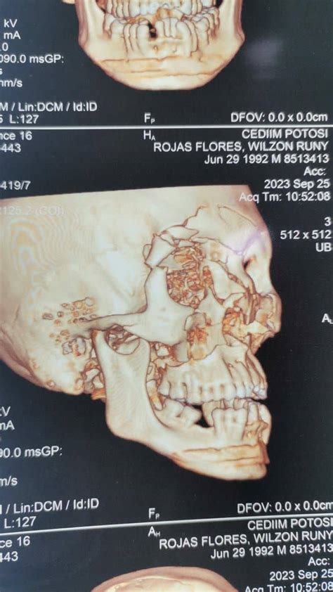 Fracturas Faciales Cirujano Maxilofacial Santa Cruz Centro De