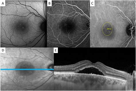 Bacillary Layer Detachment Associated With Photodynamic Therapyrelated