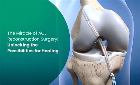 The Miracle of ACL Reconstruction Surgery