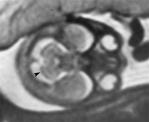 Single Shot Fast Spin Echo Mr Imaging Of The Fetus A Pictorial Essay