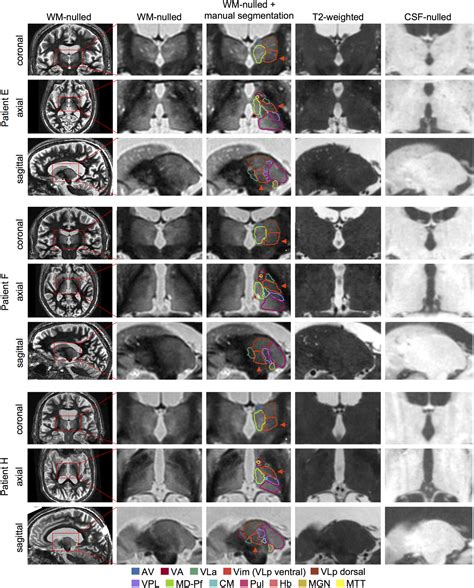 Improved Vim Targeting For Focused Ultrasound Ablation Treatment Of Essential Tremor A