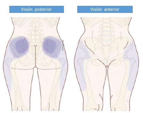 Dolor Facetario Lumbar Dolopedia