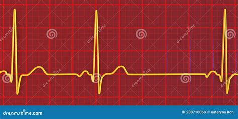 Electrocardiogram Ecg Displaying Sinus Arrhythmia D Illustration