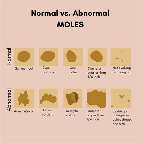Normal Moles Vs Abnormal Moles