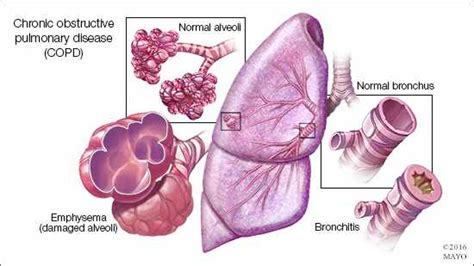 Cord Pulmonar Cronic Simptome Cauze Si Tratament Doftoriaro Porn Sex