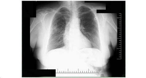 Chest Radiography Showed A Small Area Of Right Perihilar Infiltration