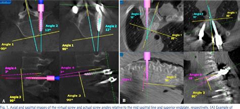 Figure 1 From Reliability Of The Planned Pedicle Screw Trajectory