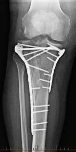 Tibial Plateau Fracture | Diagnosis & Treatments | Reno Orthopedic Center