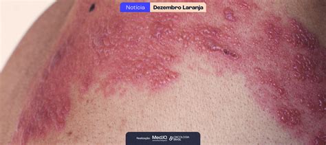 Caso Raro Destaca Risco De Melanoma Decorrente De Queimadura