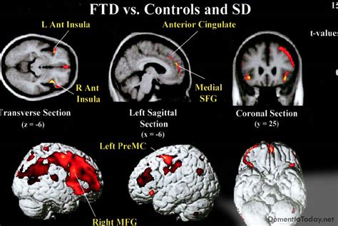 What is frontotemporal dementia?