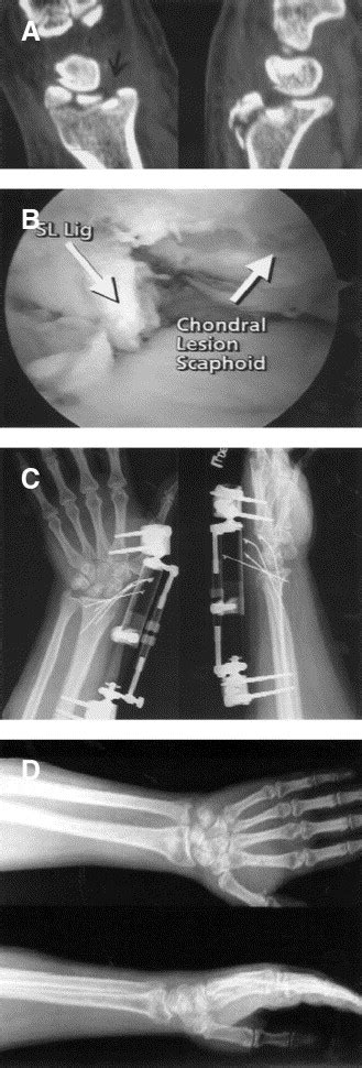 Arthroscopic Reduction Versus Fluoroscopic Reduction In The Management