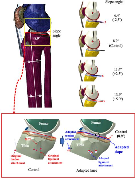 Importance Of Posterior Tibial Slope In Joint Kinematics With An