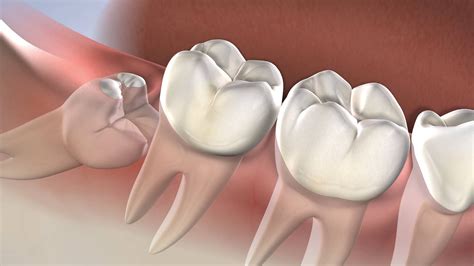 Wisdom Teeth Removal In Sydney What To Expect Wisdom Teeth Day Surgery