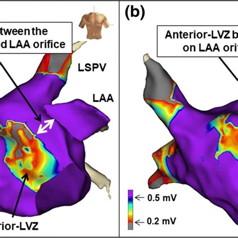 Left Atrial La Electro Anatomical Maps Created During Sinus Rhythm