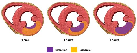 Myocardial Ischemia And Infarction Ekg Essentials A Student Handbook