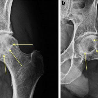 A Preoperative Anteroposterior Ap Radiograph Demonstrating Femoral