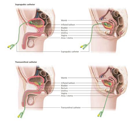 Indwelling Bowel Catheter