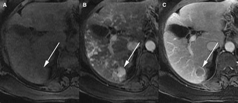 Major Diagnostic Features Of Hcc Include Arterial Phase Download Scientific Diagram