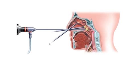 Functional Endoscopic Sinus Surgery Fess • Atlas Hospital