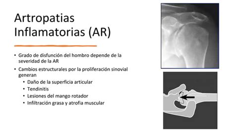 Artrosis De Hombro Pptx