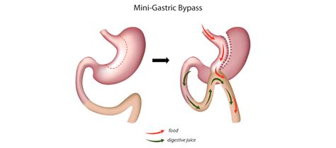 Mini Gastrik Bypass Ameliyatı Prof Dr Hasan Altun