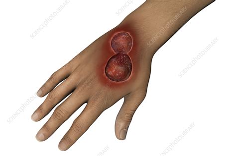 Buruli Ulcer On A Hand Illustration Stock Image F