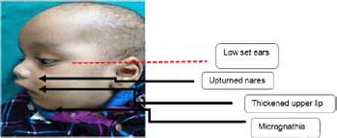 Figure 2 from Miller–Dieker syndrome with hydronephrosis | Semantic Scholar