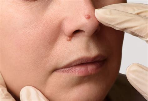 Carcinome Sur Le Nez Quel Traitement Centre Chirurgie Dermatologique Paris