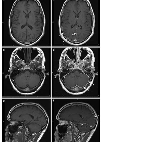 T Weighted Pre And Post Contrast Sequences Showing Contrast