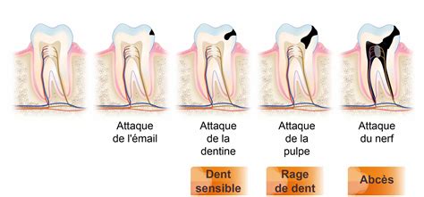 Synthétiser 18 articles sur le sujet pulpite dentaire que faire