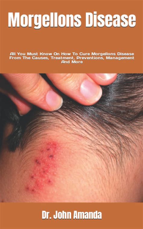 Morgellons Disease All You Must Know On How To Cure Morgellons Disease