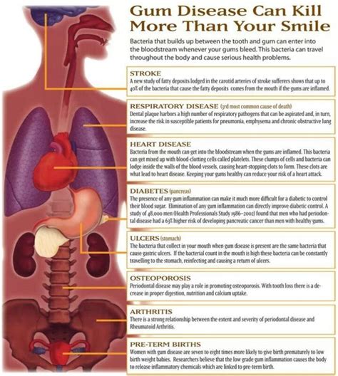 Gingivitis Can Kill You