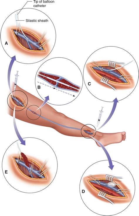 Surgical Thrombectomy For Deep Vein Thrombosis Springerlink